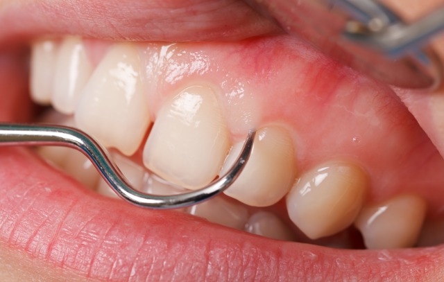 歯ぐきの下の歯石除去